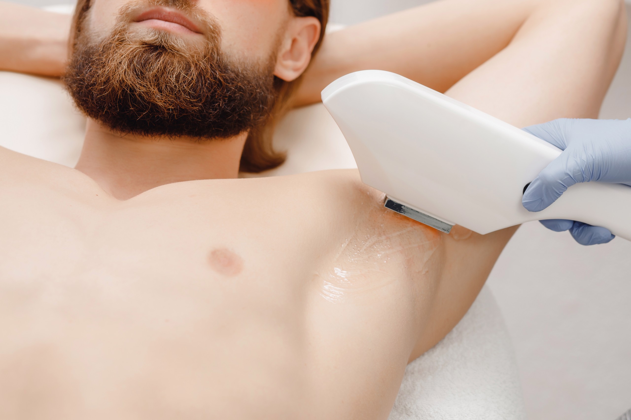 laser hair removal men
